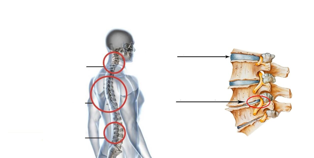 servikal omurganın osteokondrozu ile yüksek tansiyon